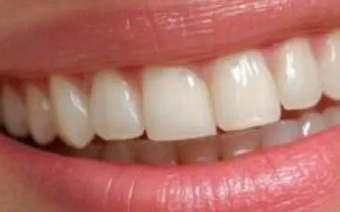 Close extremo de sorriso com dentes claros, textura natural do esmalte