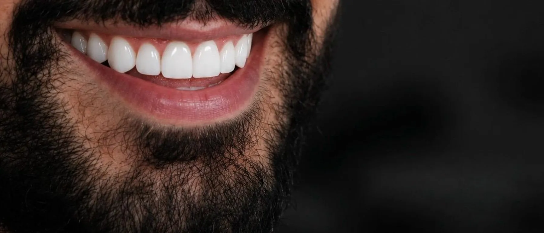 Close de sorriso natural com dentes alinhados e brancos, resultado de facetas de resina