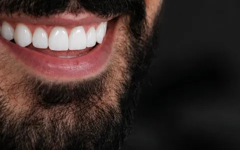 Close de sorriso natural com dentes alinhados e brancos, resultado de facetas de resina