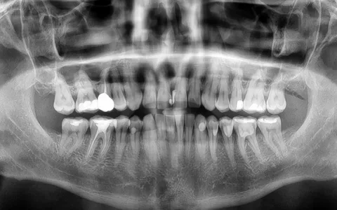 Radiografia panorâmica odontológica em preto e branco mostrando os dentes e raízes