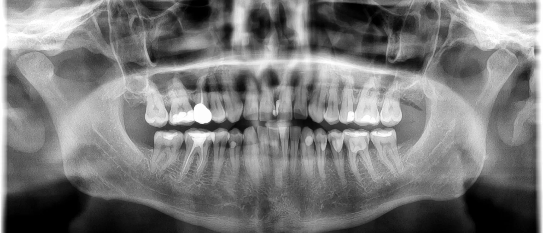 Radiografia panorâmica odontológica em preto e branco mostrando os dentes e raízes